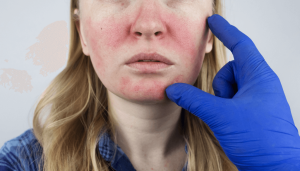 Common Rosacea Triggers