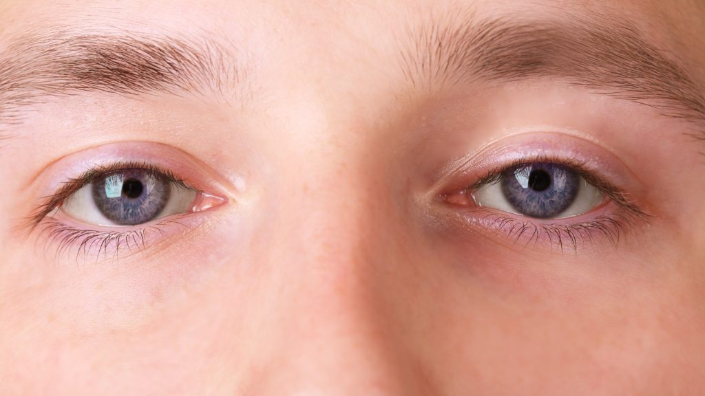 How To Get Rid Of Lazy Eyelids? Non-Surgical & Surgical Options