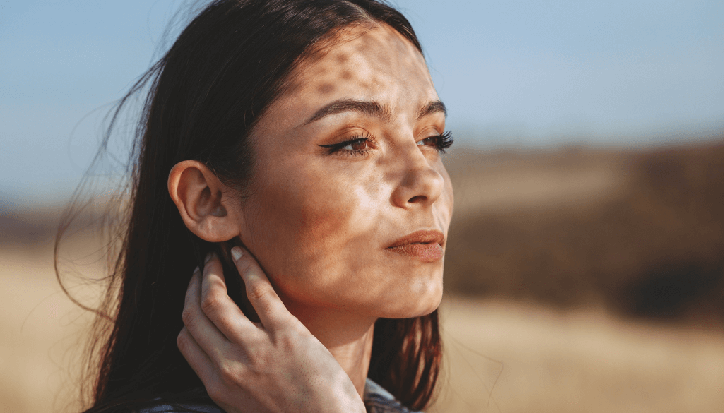 Best Treatment for Sun Damaged Skin on Face