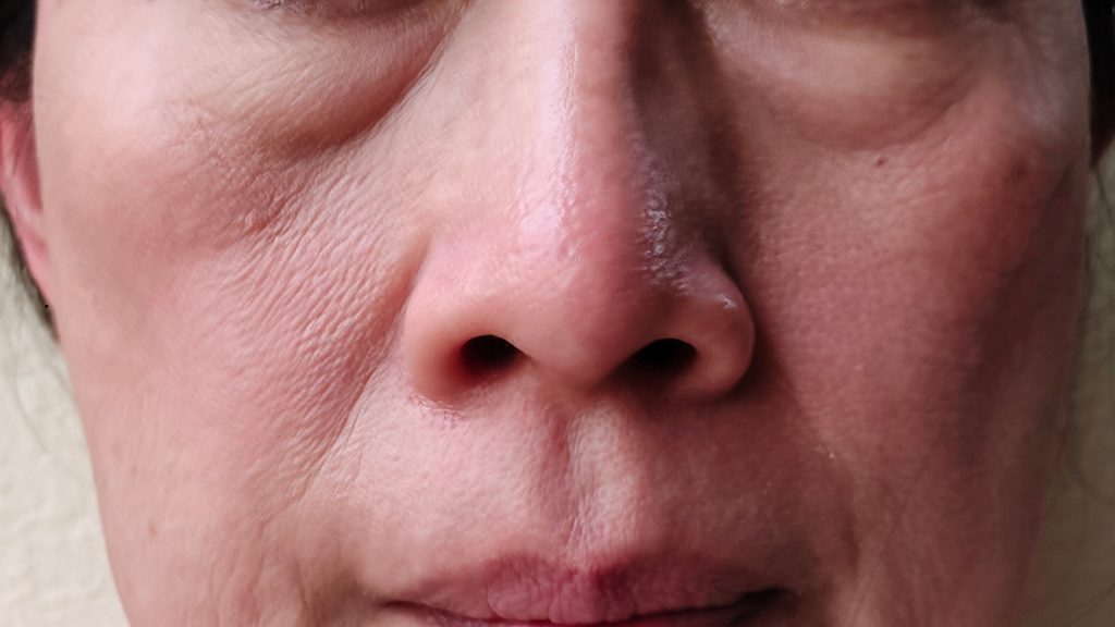 Saggy Skin Under Eyes