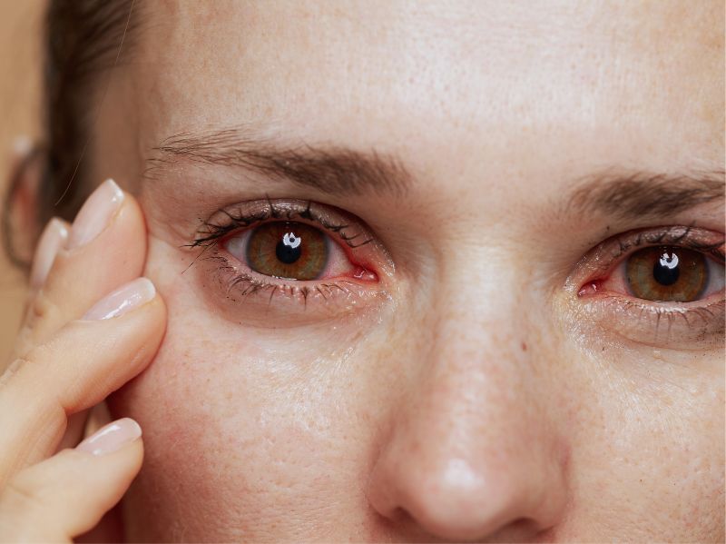 Eye Irritation: Causes, Remedies, and Treatments