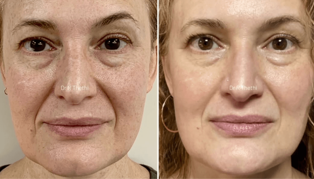 How to Remove Freckles Permanently? Options That Work Fast