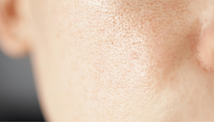 How to Shrink Pores Permanently