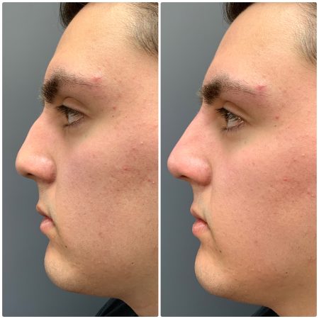 Non Surgical Rhinoplasty before & after