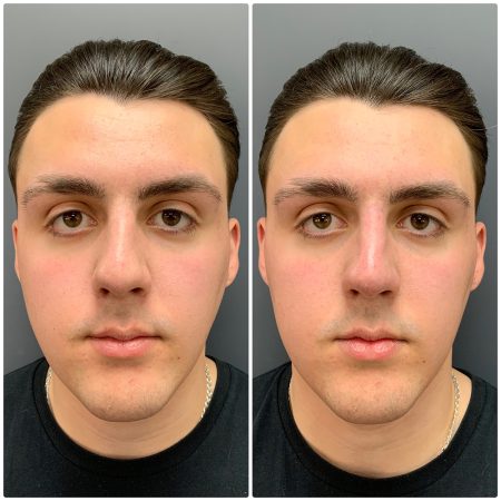 Non Surgical Rhinoplasty Before & after result