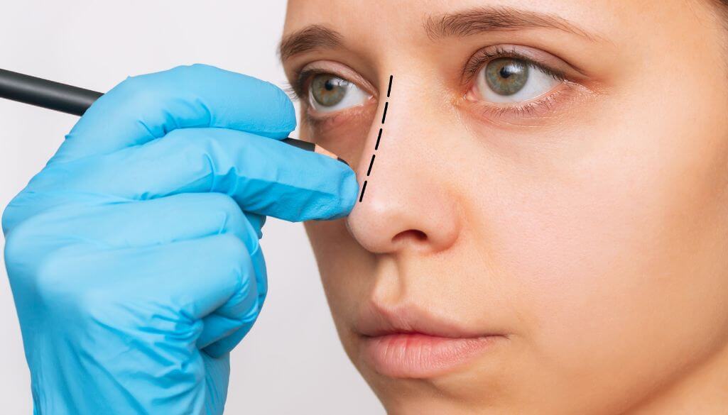 Crooked Nose: Causes, Symptoms & How to Fix It