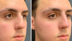 Nose reshaping with Fillers
