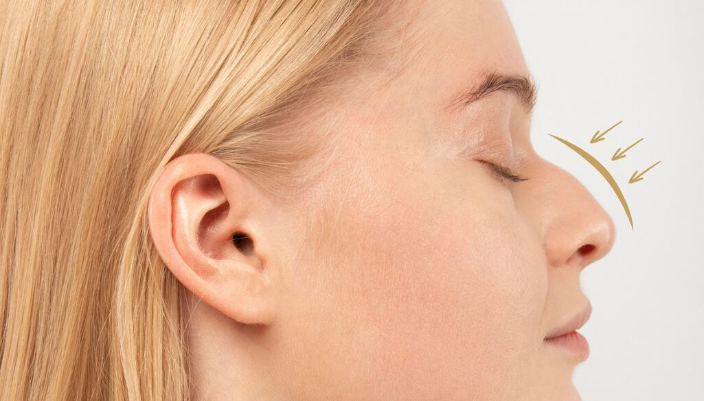 Roman Nose: Characteristics, Meaning & Non-Surgical Fix