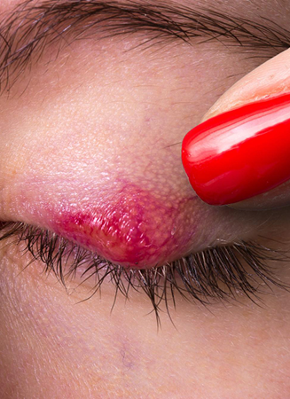 chalazion treatment
