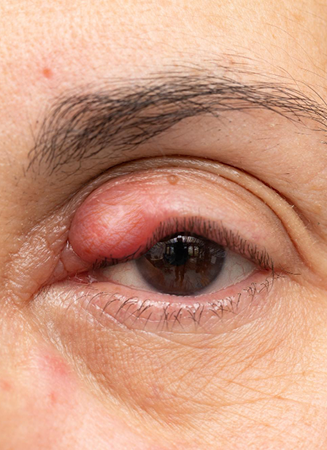 chalazion treatment1