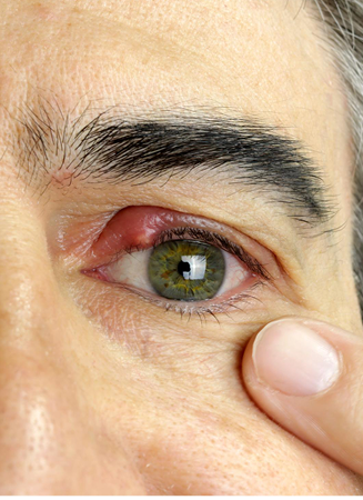 chalazion treatment2