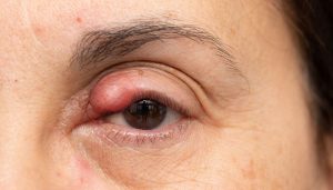Chalazion Healing stages