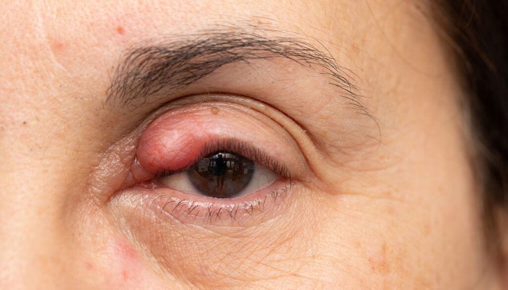 Chalazion Healing Stages:  Timeline & Care Tips