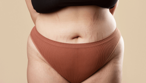 FUPA (Fat Upper Pubic Area)