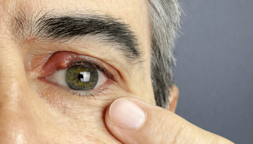 How Long Does a Chalazion Last? Recovery & Treatment