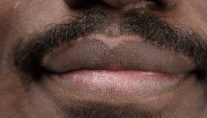 Lip Hyperpigmentation
