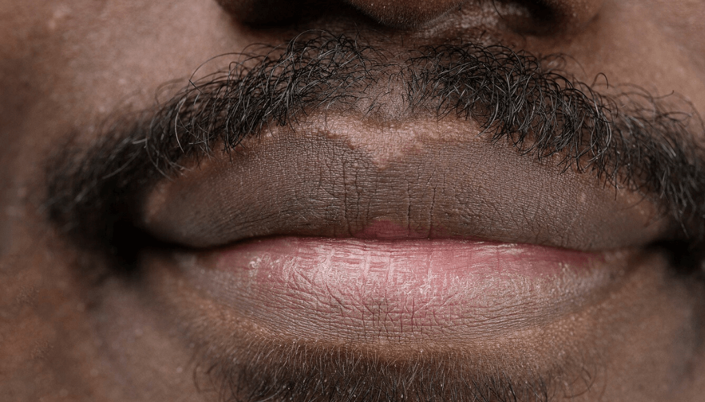 Lip Hyperpigmentation: Causes, Types, & Treatments for Dark Lips