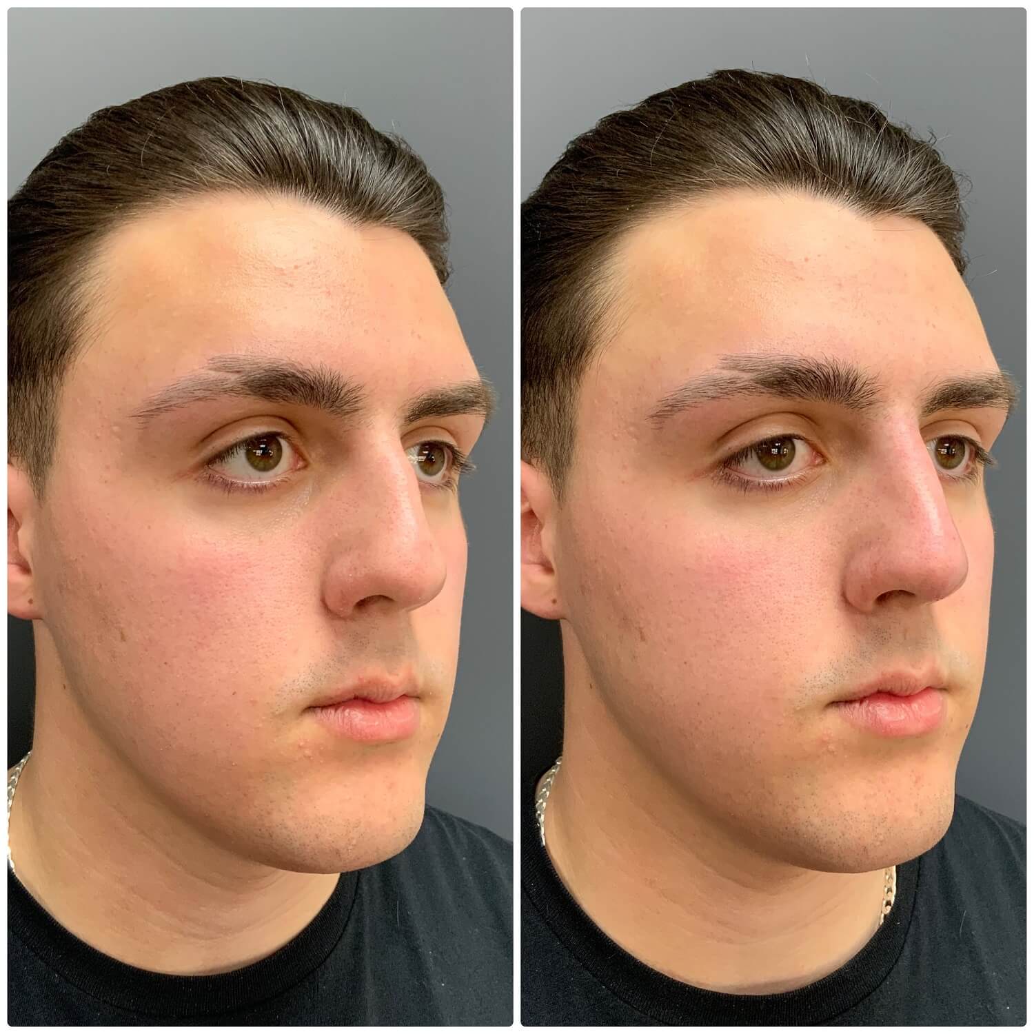 Non surgical rhinoplasty before after 3