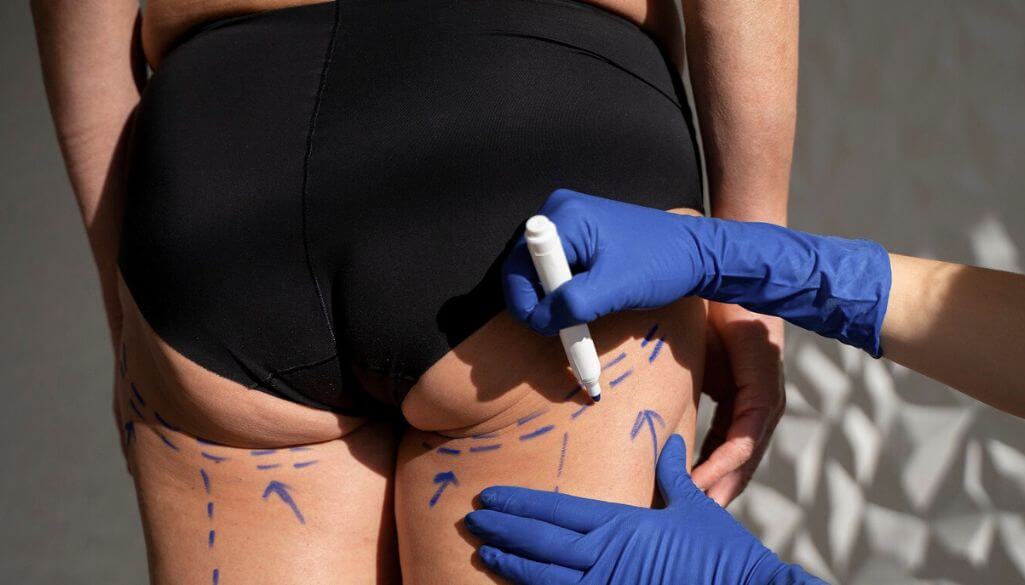 Ozempic Butt: Causes & How To Treat It?