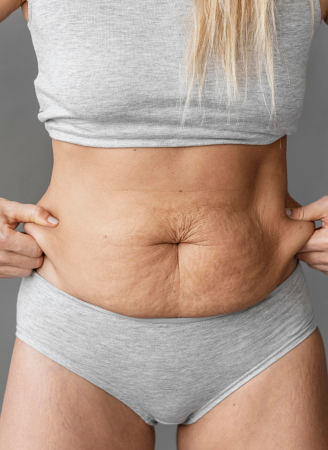 Tummy Tuck1