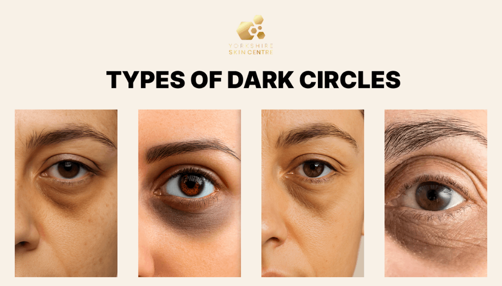 Types of Dark Circles: Which Type You Have & How To Treat It?