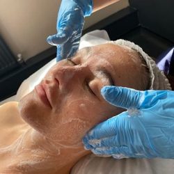 Chemical Peel Treatment in Leeds