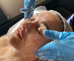 Chemical Peel Treatment in Leeds