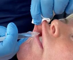 Lip Fillers in Leeds