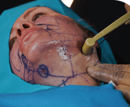 Improved jawline definition with Neck Tightening Treatment in Leeds​