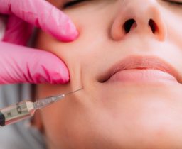 Dermal Filler for Nasolabial Lines